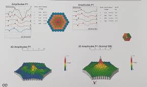 MA04- Evaluación Funcional Visual Neuro Oftalmología Electrofisiología